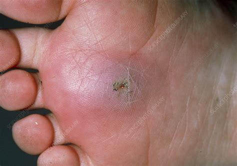 Sole Of Foot Infected Due To Foreign Body Stock Image M3300695