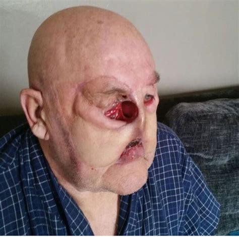 Rare Cancer Leaves A Man With Huge Hole In His Face