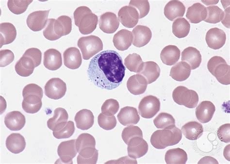 Atypical Lymphocytes Atypical Or Reactive Lymphocytes Are Lymphocytes