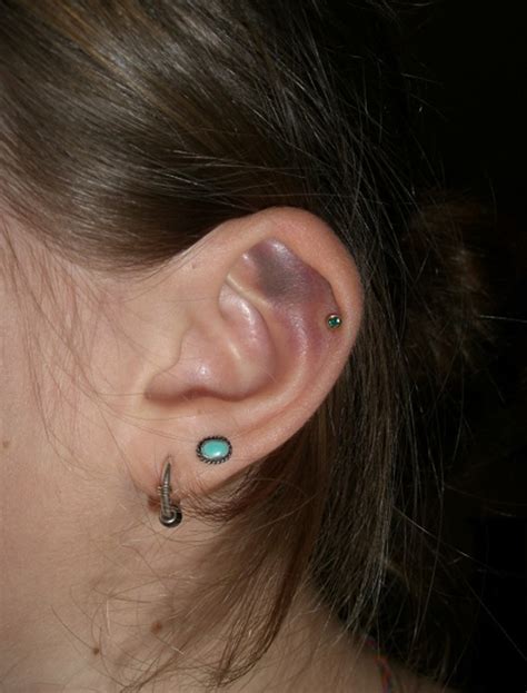 Cartilage Piercing Ear Bump Pictures Infection And Treatment