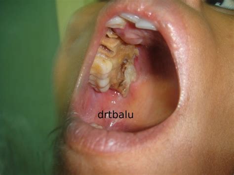 Clinical presentation the presentation can vary, ranging from exophthalmos, rhinorrhea, and ophthalmoplegia. drtbalu's otolaryngology resources: Interesting case ...