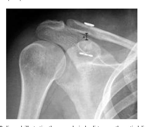 Figure 1 From Management Of Acute Acromioclavicular Joint Dislocation
