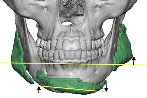 Asymmetry Of Chin And Jaw Angle Implants Front View Dr Barry Eppley