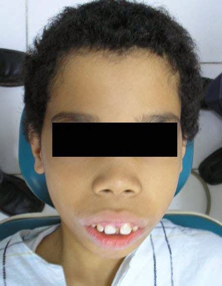 Sifats Disease Atlas Faces Of Patients In Thalassemia