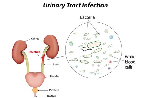 But these and other early symptoms of prostatic cancer can also come from benign prostate conditions, so diagnostic testing is important. Signs and Symptoms of Urinary Tract Infections (UTIs)