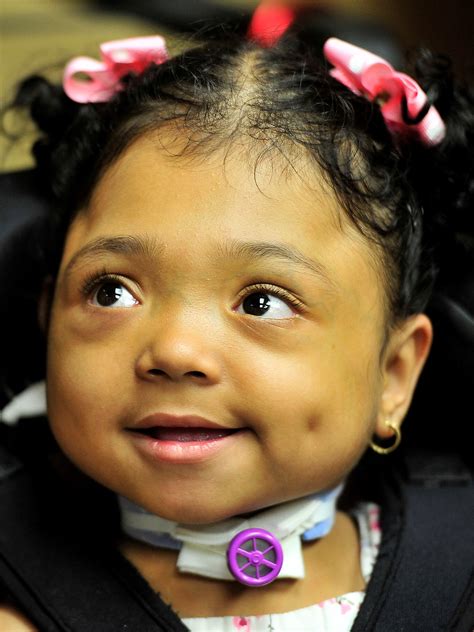 Baby Born Without Bones