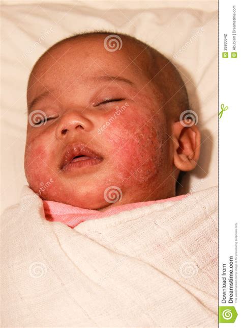 Baby With Atopic Dermatitis Stock Photography Image 26930642