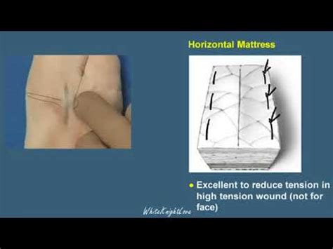 Suture technique, running horizontal mattress suture, forehead incisions, eyebrow incisions. 7 3 Horizontal Mattress Suture Techniques Essential ...