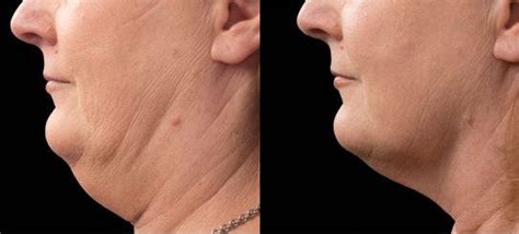 Coolsculpting Fat Freezing Before And After Photos Coolsculpting