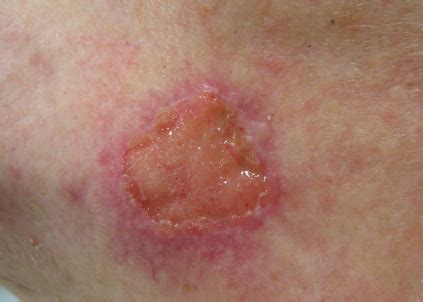 Also, this type of cancer may look like you had just caused damage to the nail from an injury. Best Skin Cancer treatment | Skin Lumps clinic