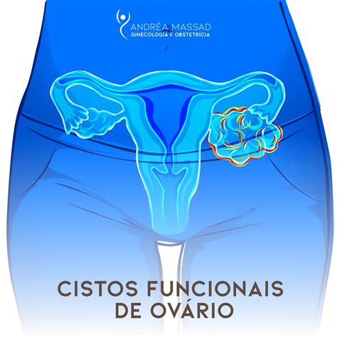 Cisto No Ovário Atrasa Menstruação