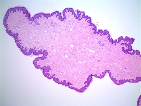 Fibroepithelial Polyp Histology