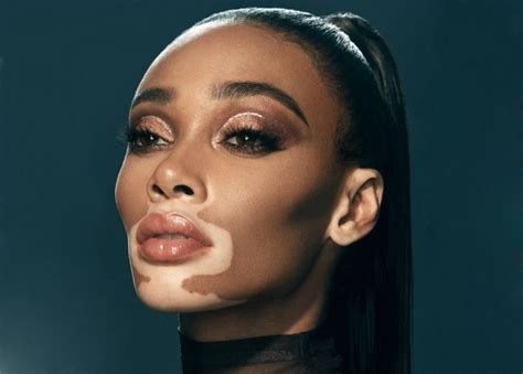 Winnie Harlow Becomes First Person With Vitiligo To Have A Beauty Line