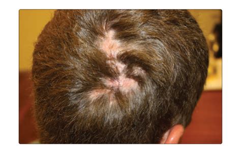 Alopecic And Aseptic Nodules Of The Scalp Pseudocysts A Really Good
