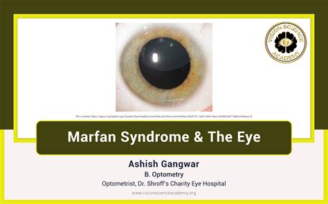 Marfan Syndrome And The Eye Vision Science Academy