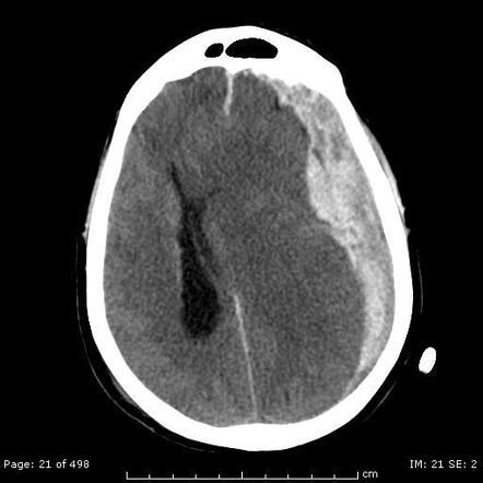 Acute On Chronic Subdural Hematoma Radiology Case Radiopaedia Org