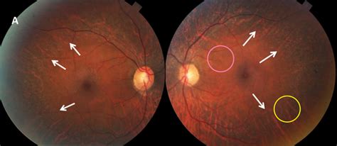 Maybe you would like to learn more about one of these? Atypical Bulls Eye Maculopathy in Hydroxychloroquine ...