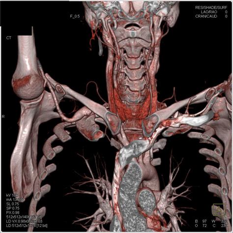Dilated Right Subclavian Artery With Cervical Rib Vascular Case