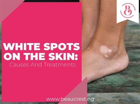 White Spots On The Skin Causes And Treatments Beaucrest