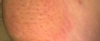 Inflammatory breast cancer's symptoms are created from the build up of fluid in the skin as a result of cancer cells creating a blockage in the lymph vessels. What does an inflammatory breast cancer rash look like ...