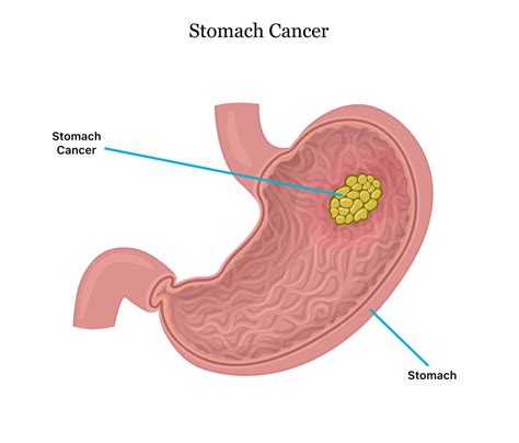 What Is Stomach Cancer