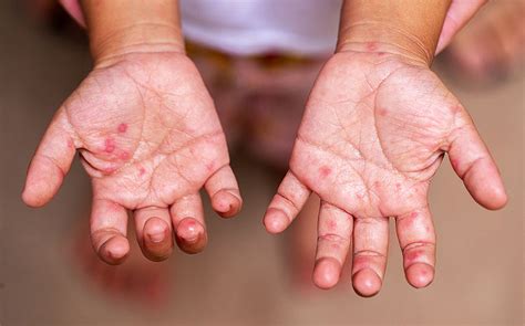 hand foot mouth disease hfmd what to do