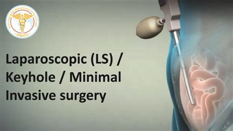 Recovery After Laparoscopic Inguinal Groin Hernia Surgery What To Expect Professor Amir Nisar