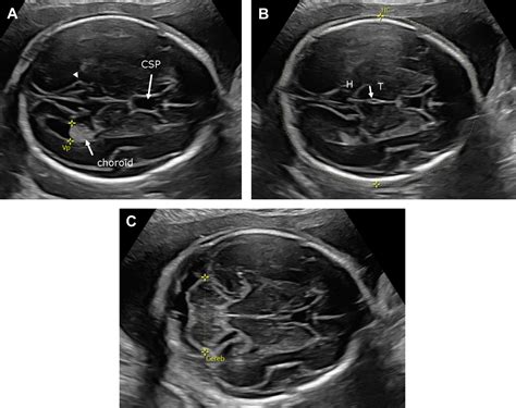 Ultrasound And Mr Imaging Of The Normal Fetal Brain Neuroimaging Clinics