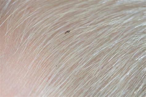 Lice Bugs In Hair