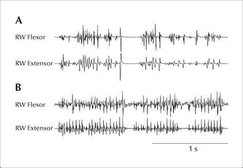 Jle Epileptic Disorders Neurophysiology Of Myoclonus And