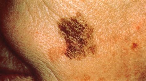 Survival Rates Of Advanced Skin Cancer Soar With Novel Treatment The