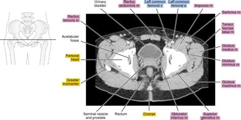 Ct Of The Male Pelvis Radiology Key