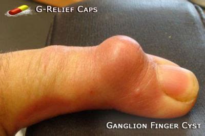 Ganglion Cyst Finger SURGERY Alternative G Relief Caps 100 Natural