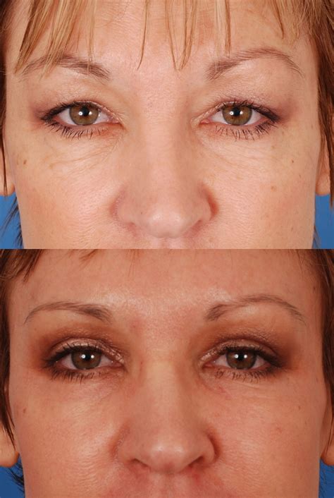 Eyelid Surgery Before And After Photos Dr Bassichis