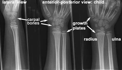 Normal Wrist Joint Child X Ray Radius And Ulna Becoming A Doctor