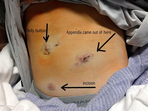 You may need care in the hospital if you have severe symptoms from a ruptured cyst. Enoch's Ruptured Appendix: Symptoms and Surgery