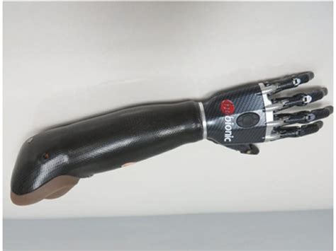 Functional Prosthetic Touch Bionic Hand Below The Elbow Myoelectric At Rs 700000 In Lucknow