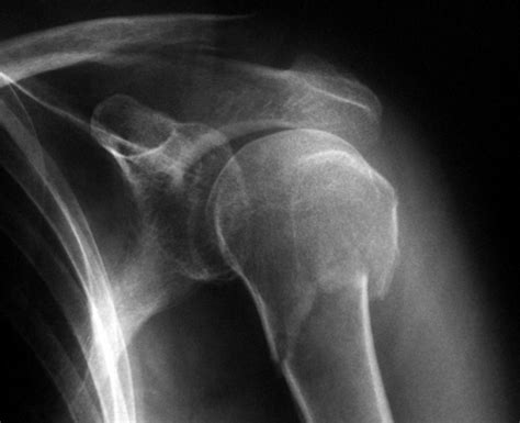 Cid Fratura Umero Proximal