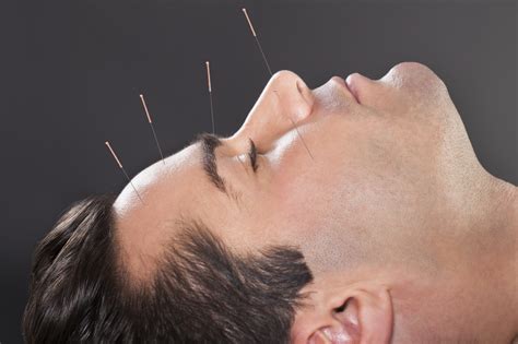 Acupuncture At Life Therapies • Life Therapies Health And Wellness
