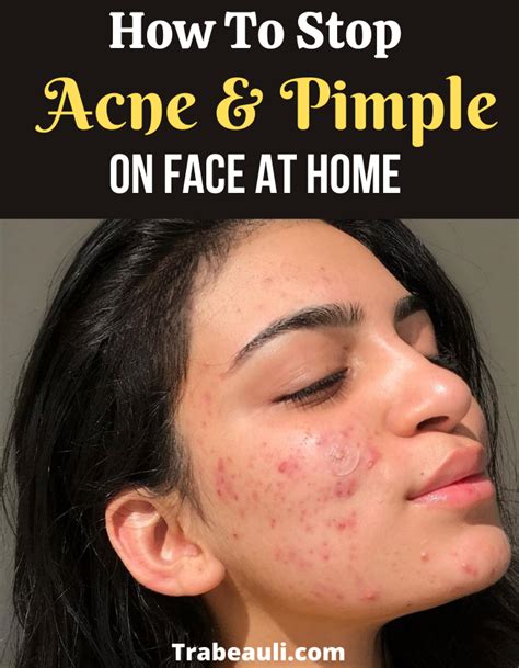 How To Get Rid Of Acne Overnight 12 Remedies That Work Artofit