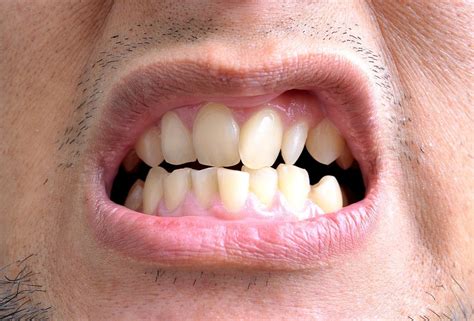 How Crooked Teeth Are Bad For Dental Health By Dr Sams Premier Dentistry