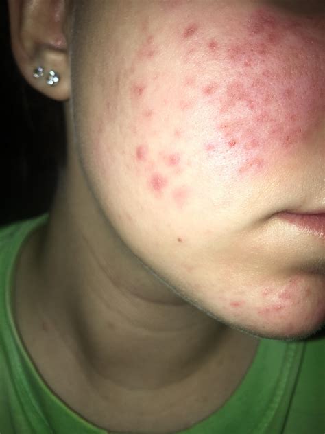 Irritated Enlarged Pores General Acne Discussion By 0kjec Acne