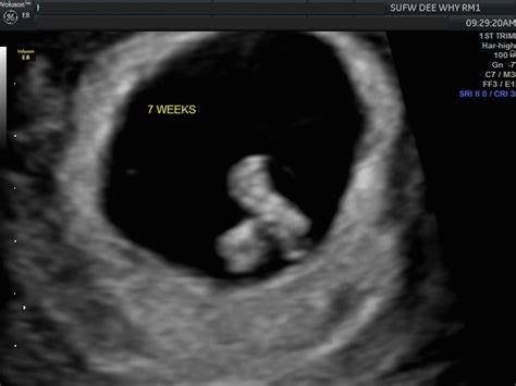 7 Week Ultrasound Identical Twins