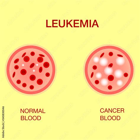 Infographic Image Of Leukemia Leukaemia Disease Awarenessleukemia