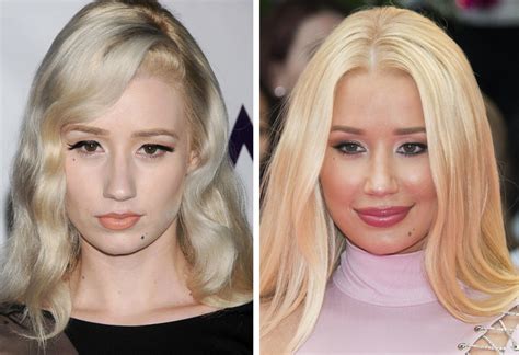 10 Popular Celebrities Before And After Plastic Surgery