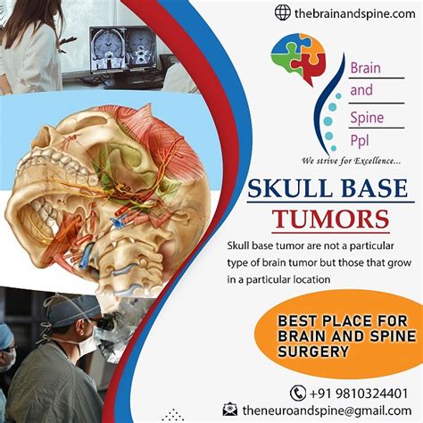 Skull Base Tumor Surgeon Delhi The Brain And Spine Delh Flickr