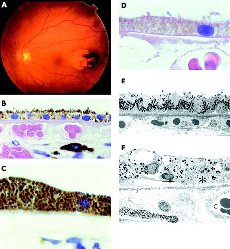 Congenital Hypertrophy Of Retinal Pigment Epithelium A Clinico