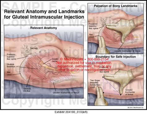 Medivisuals Relevant Anatomy and Landmarks for Gluteal Intramuscular