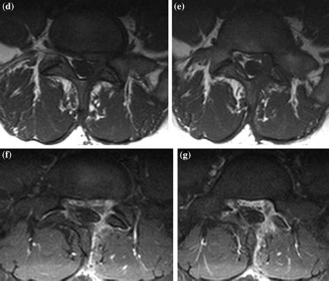 Herniated Lumbar Disk Diskectomy Radiology Key