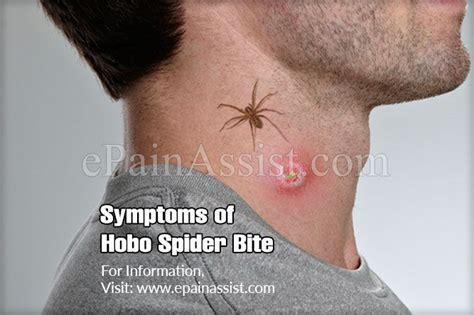 Symptoms Of Hobo Spider Bite And Its Treatment Prognosis Prevention